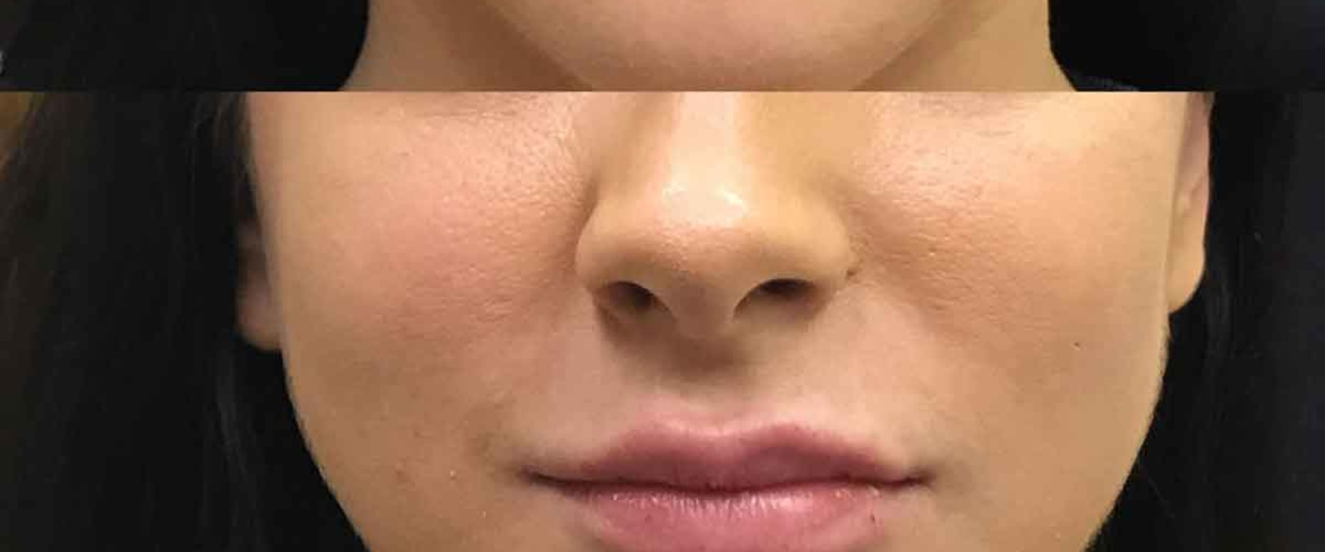 What Age is Appropriate for Restylane Injections?