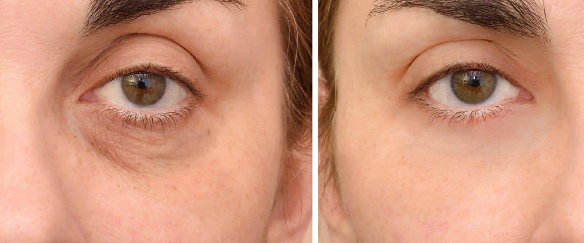 Injectable filler for Under eyes faq