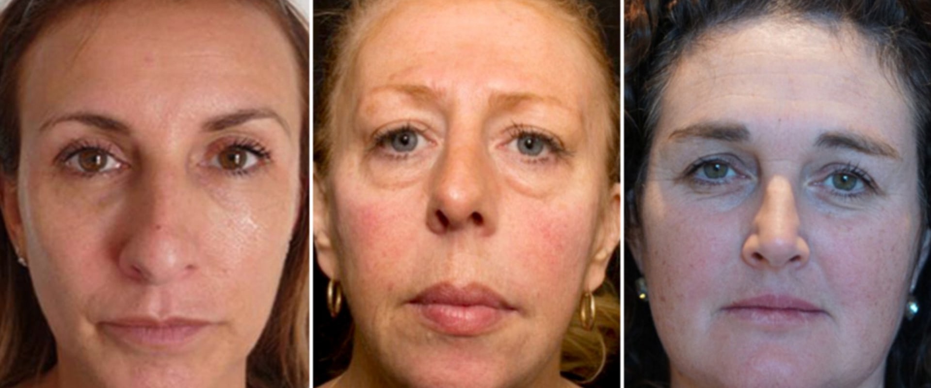 Do Fillers Make You Look Older After They're Gone?