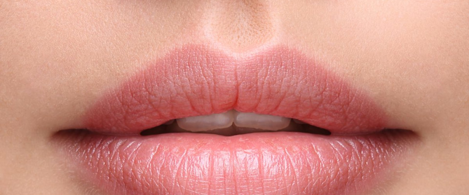 Which Restylane is Best for Lips?