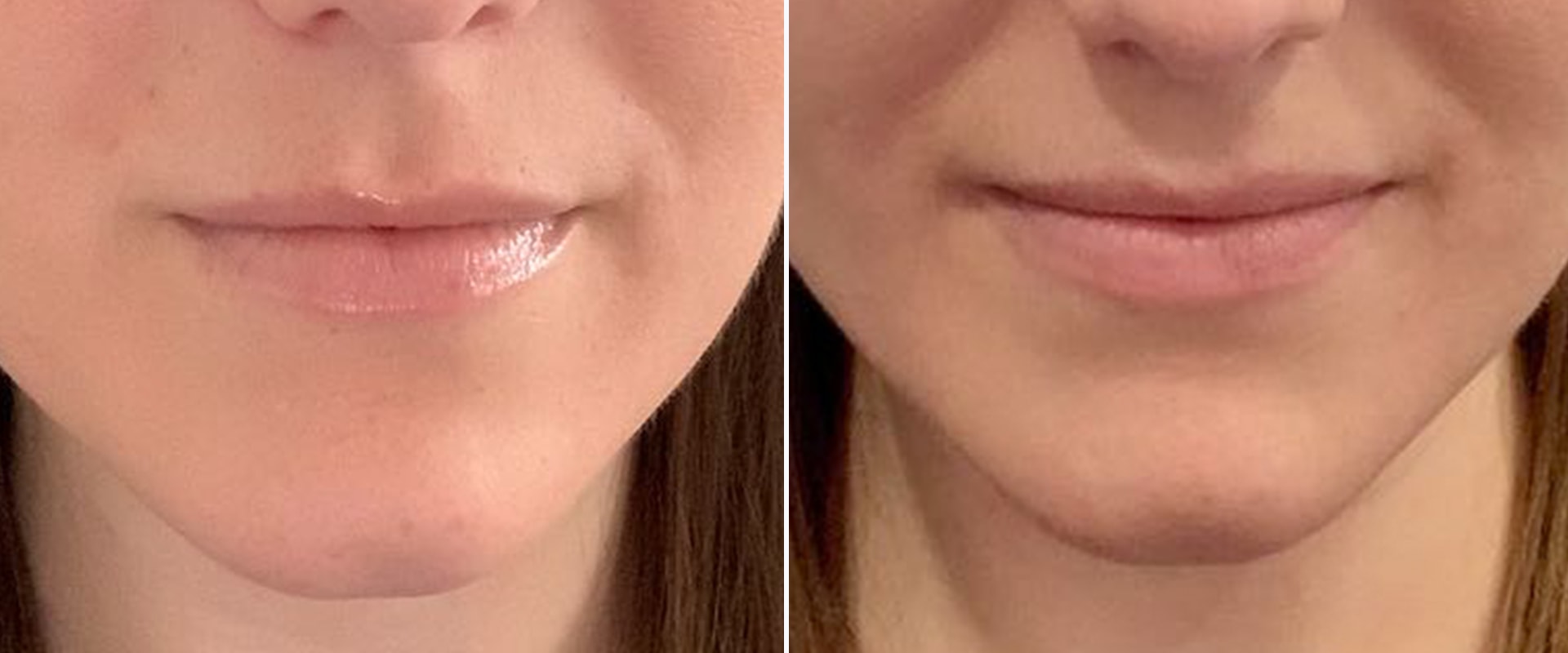 What are the Benefits of Restylane for Nasolabial Folds?