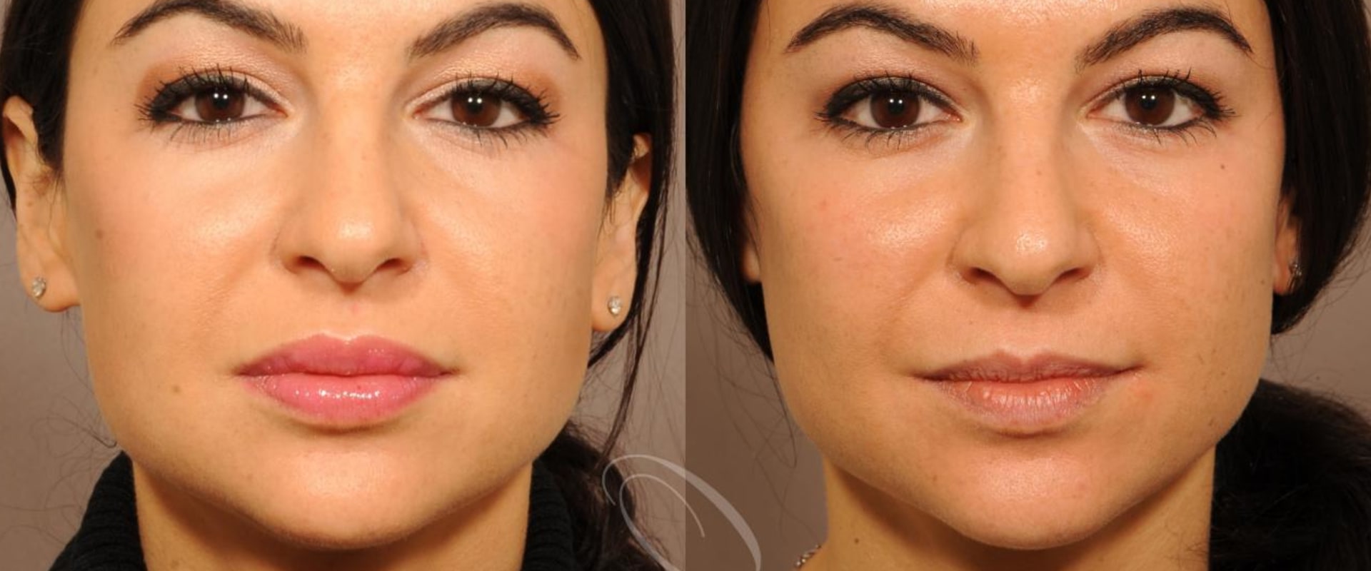 Who Can Help You Achieve Younger Looking Skin with Restylane Injections?