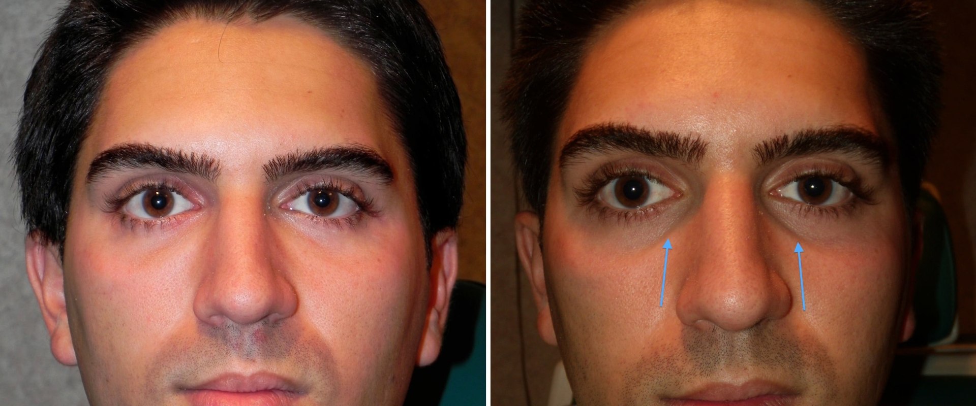 What is Restylane Under the Eyes? A Comprehensive Guide