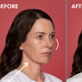 Medical Weight Loss and Beauty : Restylane for Youthful Appearance