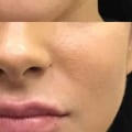 What Age is Appropriate for Restylane Injections?