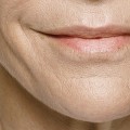 25 Years of Restylane: A Milestone in Dermal Fillers