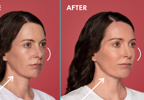 Medical Weight Loss and Beauty : Restylane for Youthful Appearance