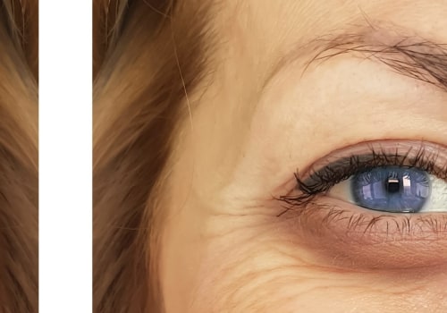 Injectable filler for Under eyes faq