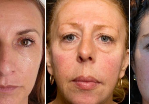 Do Fillers Make You Look Older After They're Gone?
