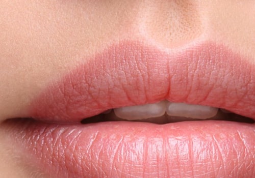 Which restylane is better for the lips?
