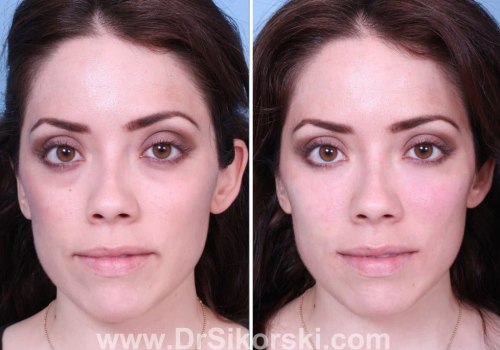 Where Can Restylane Be Used To Enhance Your Look?